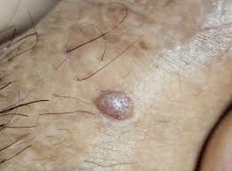 condylomes génitaux